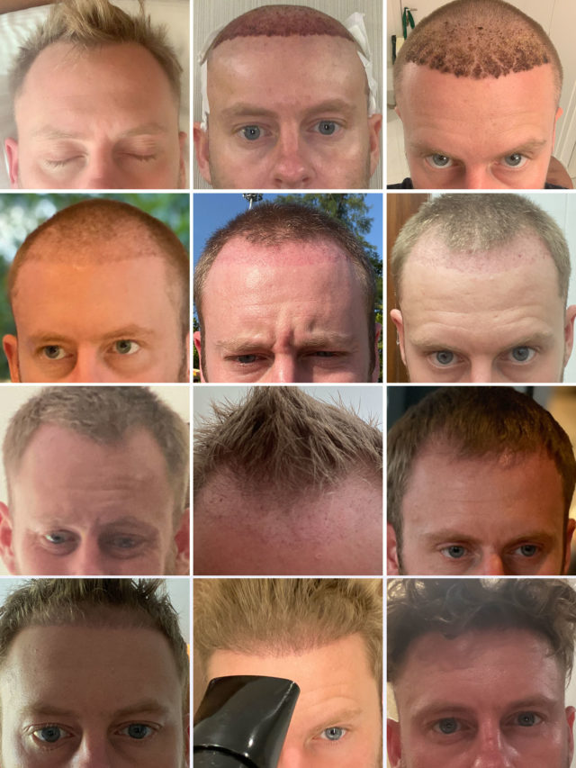 Hair Transplant from start to finish